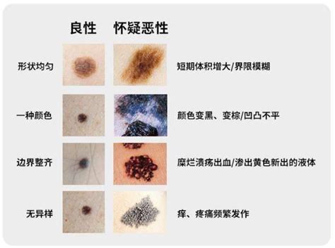 新的痣|痣也可能会癌变！长在 3 个地方要注意